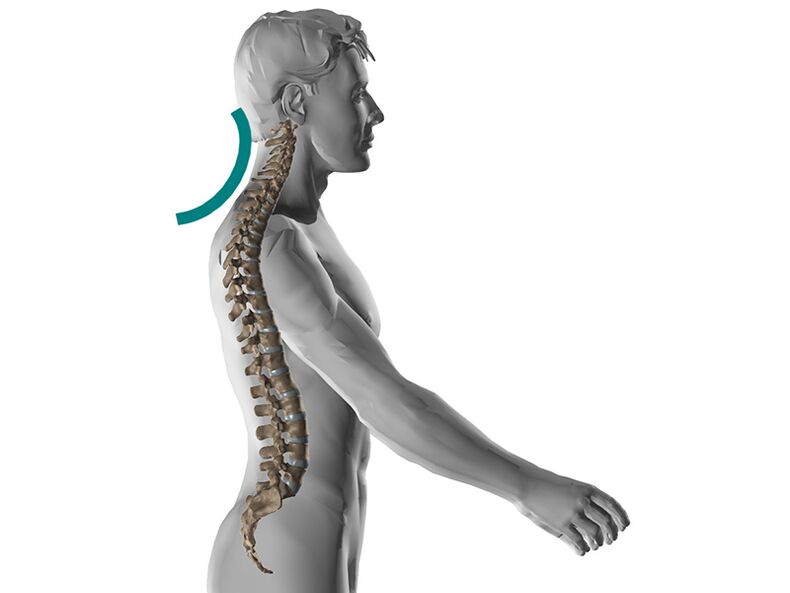 Osteocondrose cervical da columna vertebral, causando moitos síntomas desagradables